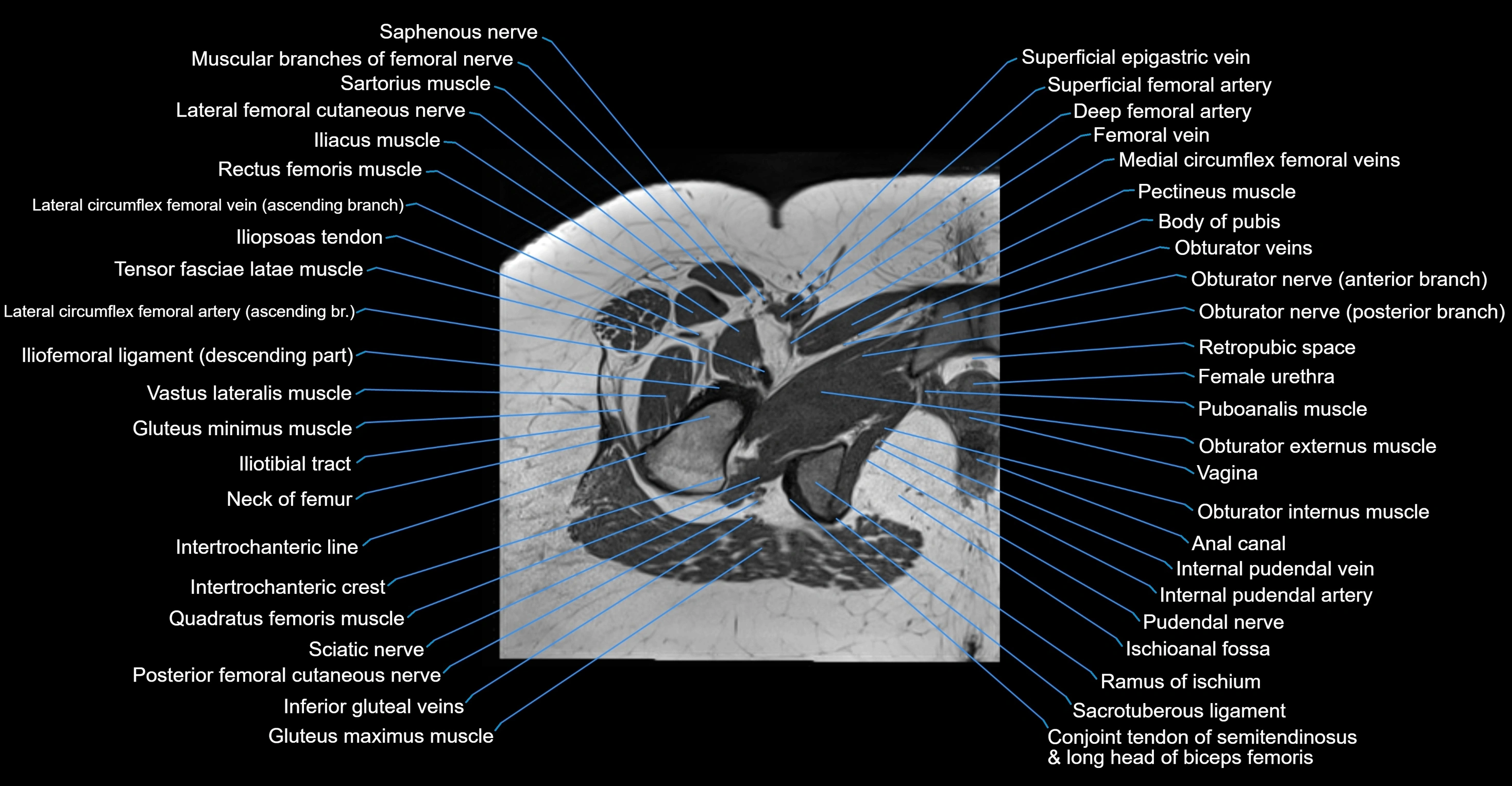 MRI hip axial cross sectional anatomy 3T 3D  radiology  anatomy image-img-00001-00054.webp